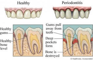 periodontal-disease (1)